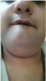 After-FUT-Follicular -Unit-Transplantation-Hair-Transplant-in-Mumbai-Face-Value-Clinic
